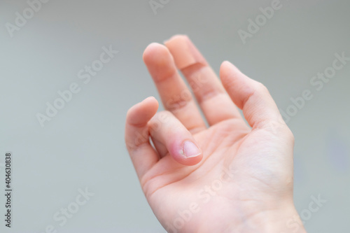 Fényképezés abscess on the finger