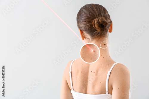 Young woman undergoing procedure of nevus removal by laser on light background photo