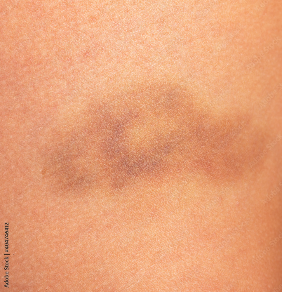 hematoma on the skin of the leg as a background hematoma on the skin of the leg as a background