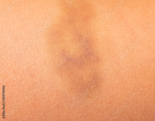 hematoma on the skin of the leg as a background