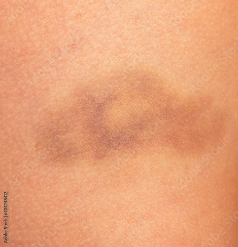 hematoma on the skin of the leg as a background