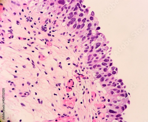 Urinary bladder biopsy showing a urothelial carcinoma in situ. The tumor has dark, enlarged cell nuclei. Minimal inflammation in the submucosa. Microscopic view. 