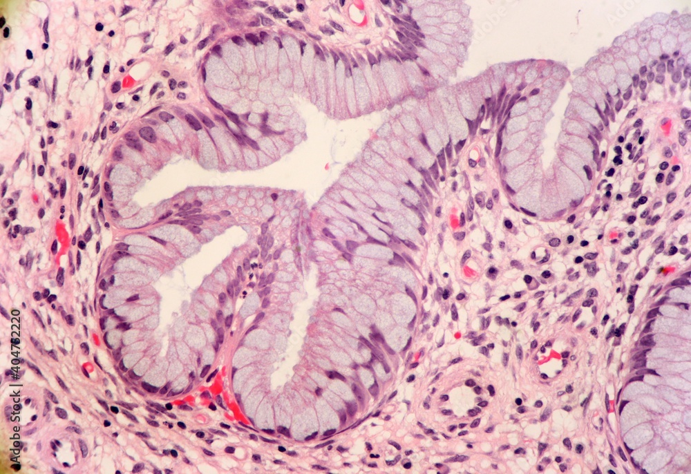Fotografie Mucus producing glands within a cervix poyp