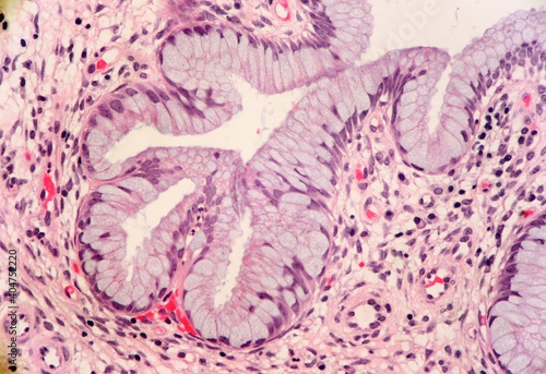 Mucus producing glands within a cervix poyp. The tissue contains various immune cells including plasma cells. Microscopic view.