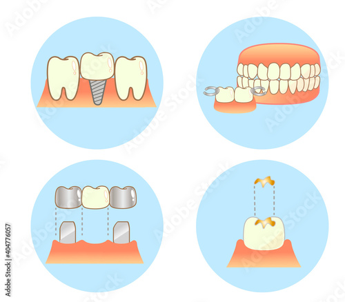 Implant Caries and Progression and Treatment: Dental Illustration