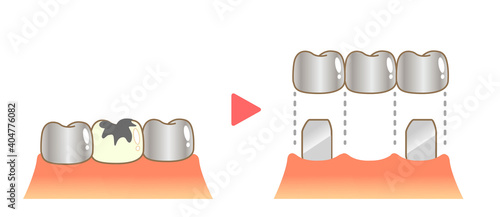 Bridge Caries and Progression and Treatment: Dental Illustration