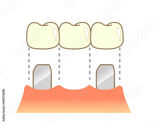 Bridge Caries and Progression and Treatment: Dental Illustration