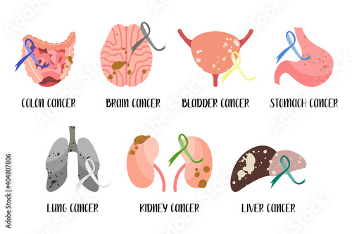 Internal human organ: colon, brain, bladder, stomach, lung, kidney, liver. Cancer, carcinoma. Awareness ribbons. Oncology. Vector flat cartoon illustration. Perfect for flyer, medical brochure, banner