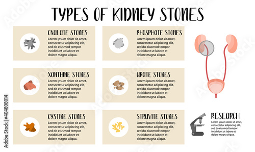 Types of kidneys stones. Oxalate, phosphate, xanthine, urate, cystine, struvite stones. Urolithiasis disease. Kidney and bladder disease. Vector flat illustration. Perfect for flyer, medical brochure