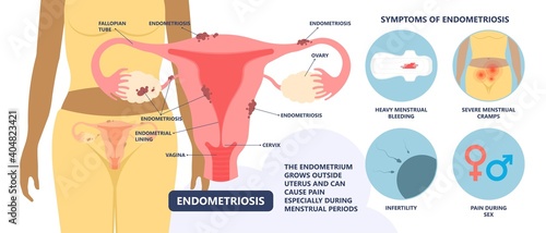 Endometriosis pain pcos tissue cancer cyst pelvic ovary lining tissue cycle sex heavy tube