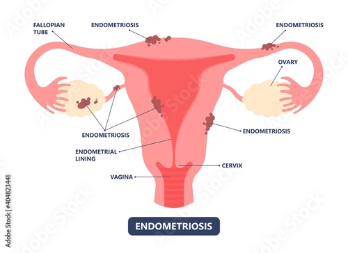 Endometriosis pain pcos tissue cancer cyst pelvic ovary lining tissue cycle sex heavy tube