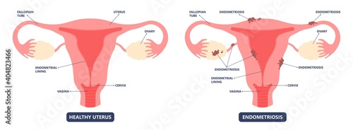 Endometriosis pain pcos tissue cancer cyst pelvic ovary lining tissue cycle sex heavy tube photo