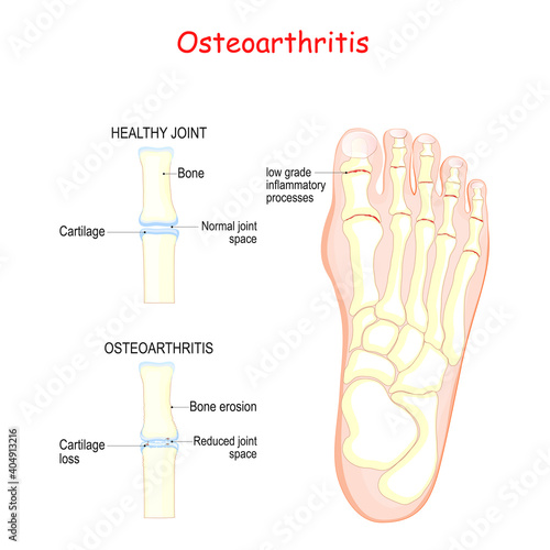 Osteoarthritis. comparison healthy joint and inflammation joint