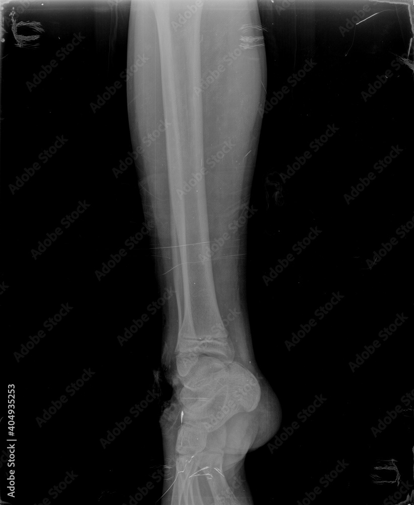 Broken x ray image of leg
Broken x ray image of leg