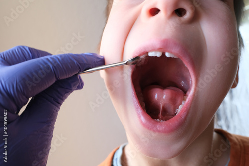 Canvas Print dentist, doctor examines oral cavity of small patient, length of frenum of the t