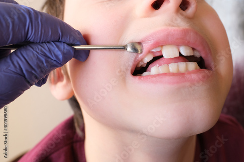 dentist, doctor examines oral cavity of small patient, molars grow, boy, kid with open mouth, close up of child’s mouth, teeth