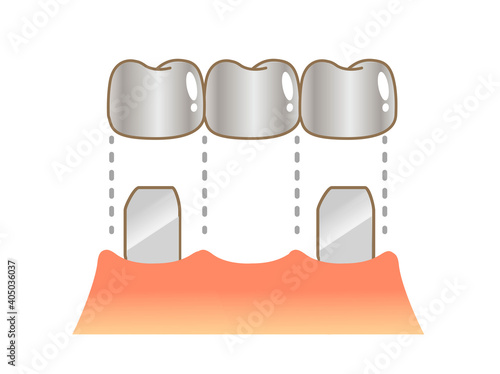 Bridge Caries and Progression and Treatment: Dental Illustration