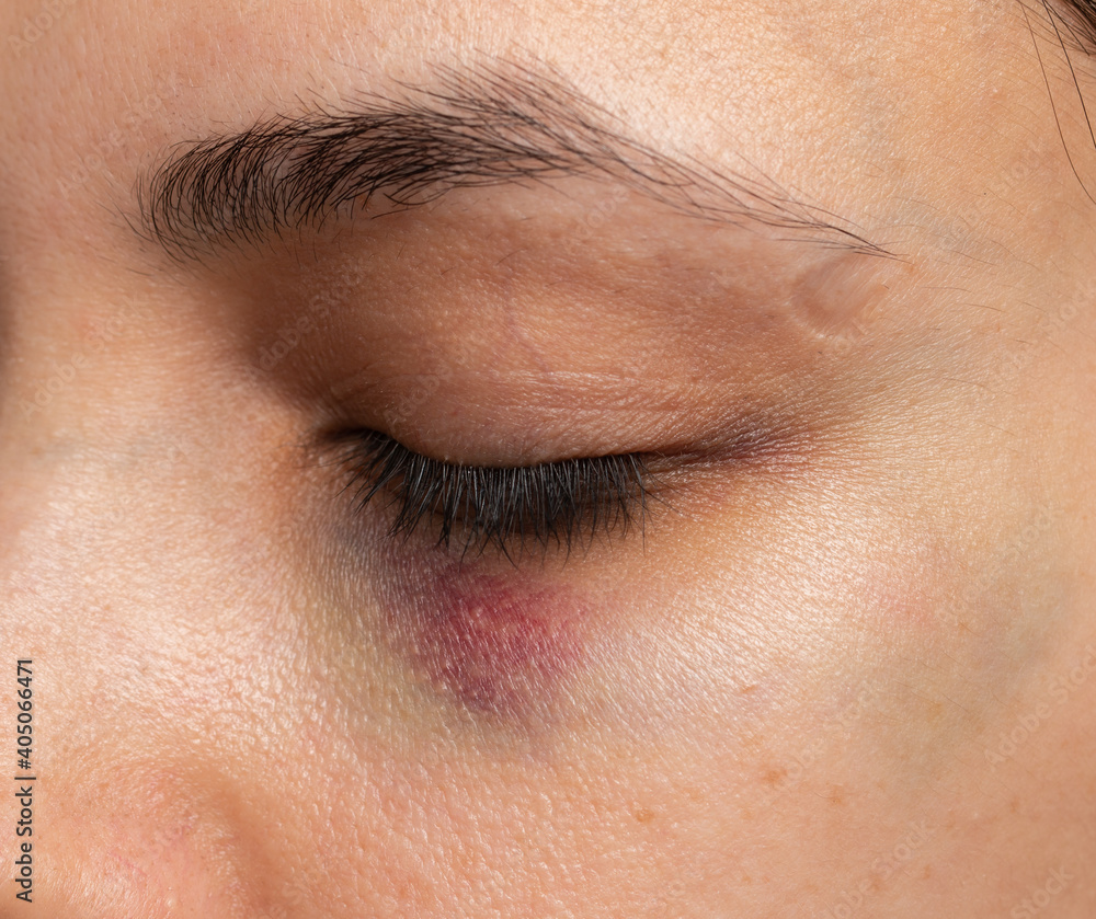 Fototapeta premium hematoma under the eye on the skin as a background