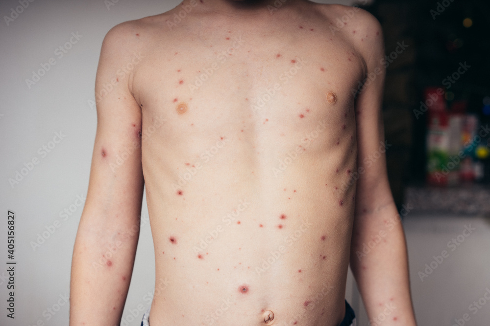 chickenpox in a child, rash. selective focus