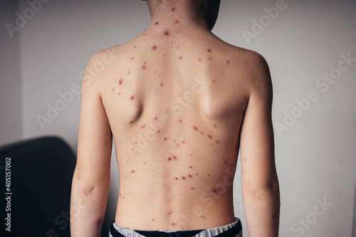 chickenpox in a child, rash. selective focus