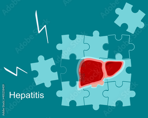 Concept of hepatitis A,B,C,D, cirrhosis.Fragile and broken liver falls apart by puzzles.World hepatitis day. Organ care. Vaccinate, threat, test. Vector in flat style. Medical banner.