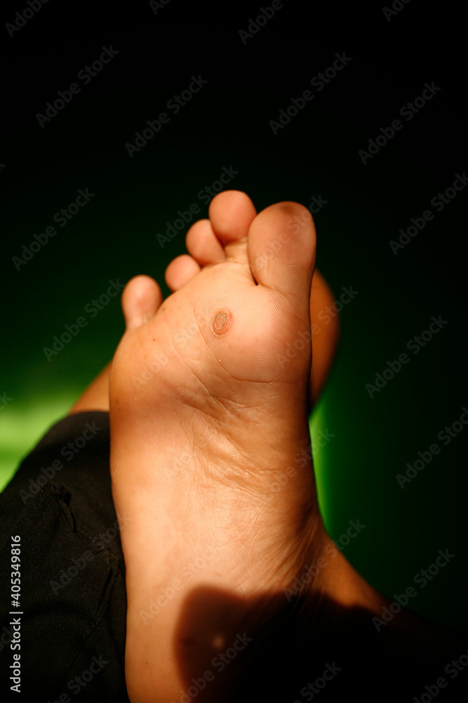 Obraz premium Calluses on foot