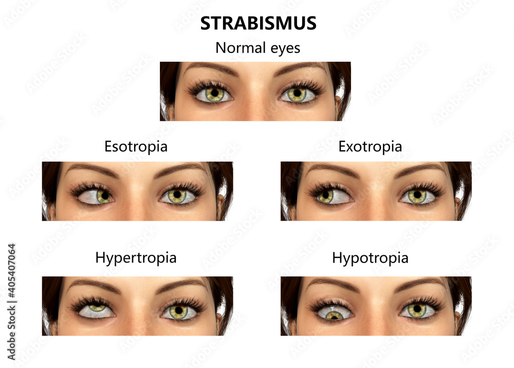 Strabismus Vision Example Strabismus, eyes deviation, illustration Stock Illustration | Adobe Stock