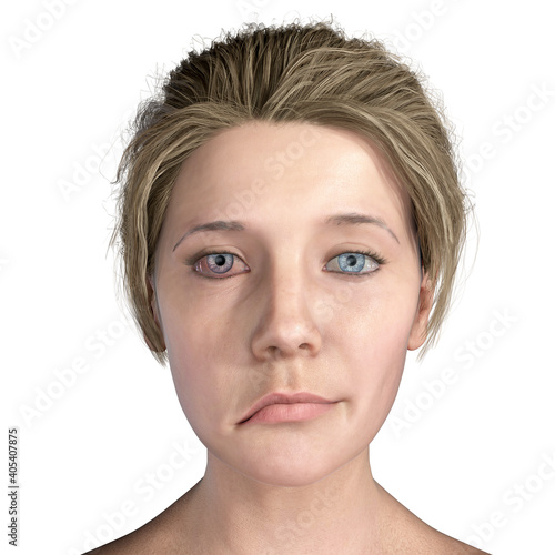Fotografie Facial nerve paralysis, Bell's palsy