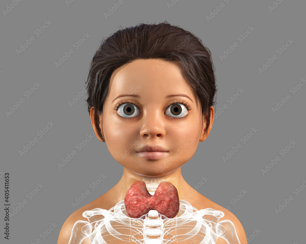 Hyperthyroidism in children, Pediatric thyrotoxicosis Hyperthyroidism in children, Pediatric thyrotoxicosis