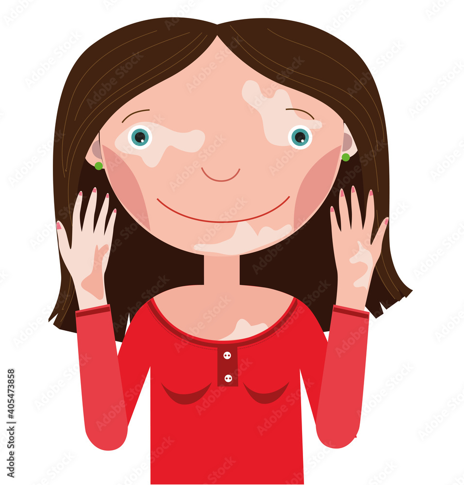 Happy girl with vitiligo on a white background Happy girl with vitiligo on a white background