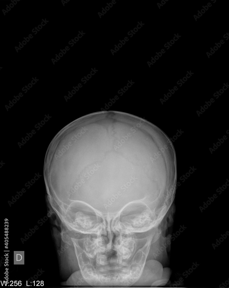 Head xray image of the baby film.The scan show normal child skull