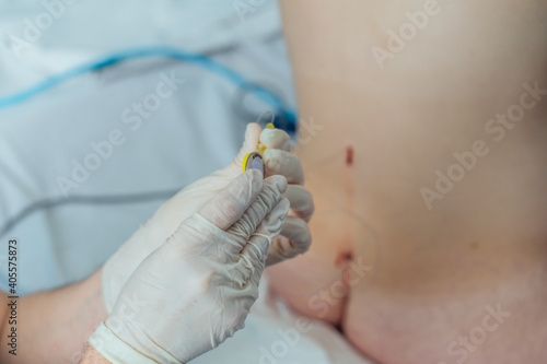 Unrecognizable doctor applying injection in the spine with anesthesia. woman has an epidural anesthesia by childbirth.
