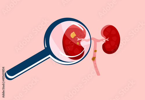 Scrutiny Kidney stone with magnifying glass.Nephrology.Pyelonephritis and renal failure disease.Inflammation in organ,cystitis chronic illness.Problem with filtration,dialysis.Vector in flat style