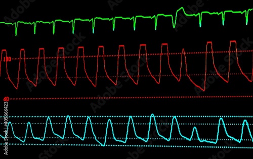 EKG, Pulse, BP and Respiration ICU Monitor Screen photo