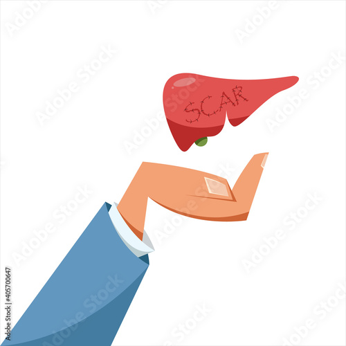 The hand that holds the scarred liver after surgery. Treatment of the liver after cerosis. Liver treatment prevention medical concept. Scar on liver.