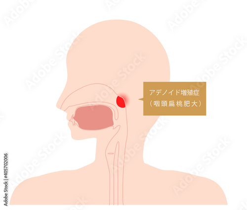 アデノイド肥大　炎症イラスト