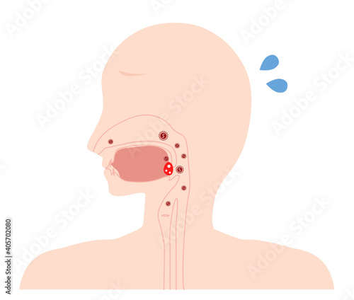 扁桃腺炎　炎症イラスト