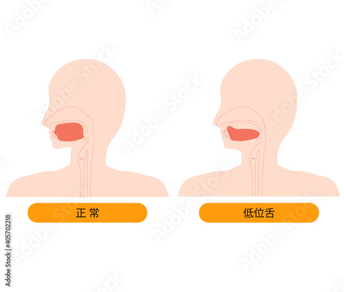 正しい舌の位置と低位舌のイラスト