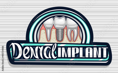 Vector logo for Dental Implant Clinic, dark decorative sign board with illustration of porcelain molar with screw, unique calligraphy lettering for words dental implant for professional denture clinic