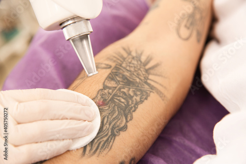 Young man undergoing laser tattoo removal procedure in salon  closeup