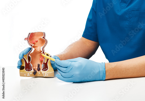 Tableau sur toile Proctologist pointing pen rectum pathologies on an anatomical model