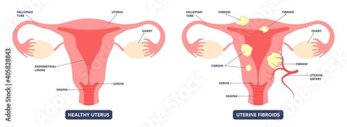 womb cancer level hormone Heavy Bleeding fertility problem infertility block tube cervix pain infection inflammation biopsy lining tumor cyst Surgical removal sessile pedicle menstruation and blood photo