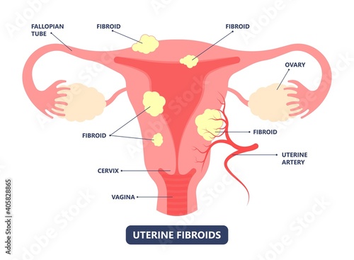 womb cancer level hormone Heavy Bleeding fertility problem infertility block tube cervix pain infection inflammation biopsy lining tumor cyst Surgical removal sessile pedicle menstruation and blood