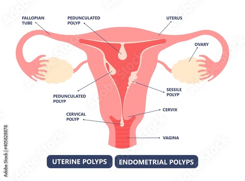 womb cancer level hormone Heavy Bleeding fertility problem infertility block tube cervix pain infection inflammation biopsy lining tumor cyst Surgical removal sessile pedicle menstruation and blood