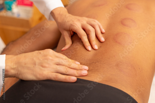 Close em mãos de terapeuta fazendo massagem em costas de paciente que está com marcas de ventosas.