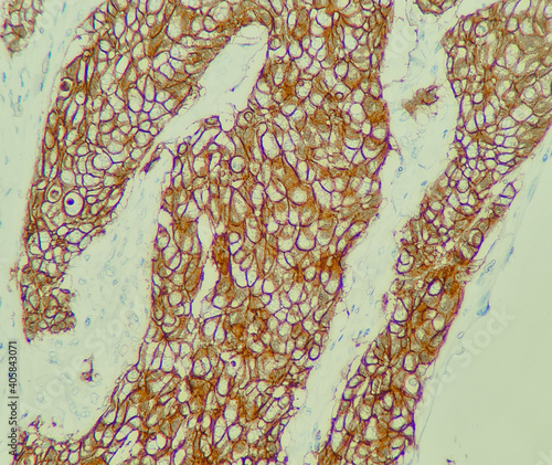 Photo of breast cancer shows positive result of HER2 stain, photo under microscope, magnification 400x