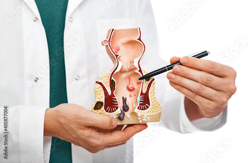 Treatment of rectal diseases, hemorrhoid. Proctologist pointing pen rectum pathologies on an anatomical model photo