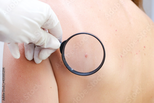 doctor examines the growths on the skin of an adult with a magnifying glass, diagnosis of skin cancer.