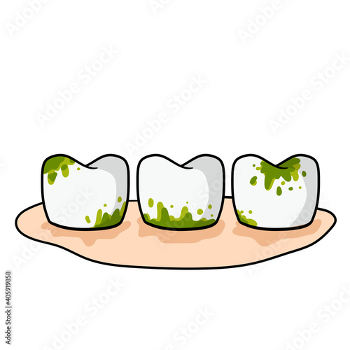 Caries and dental problems. Dentistry and sick dirty teeth with stains. Oral hygiene. Medical care. Gingivitis. The need for cleaning. Tooth decay. Cartoon illustration