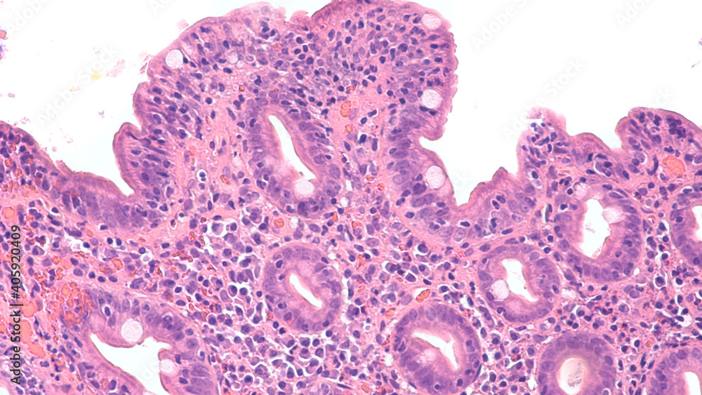 Αυτοκόλλητο Histology of duodenal biopsy from patient with bloating and diarrhea from celiac